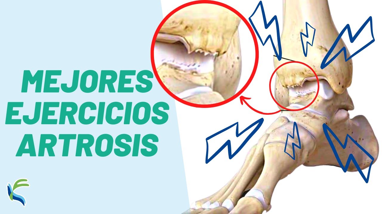 artrosis en los pies ejercicios