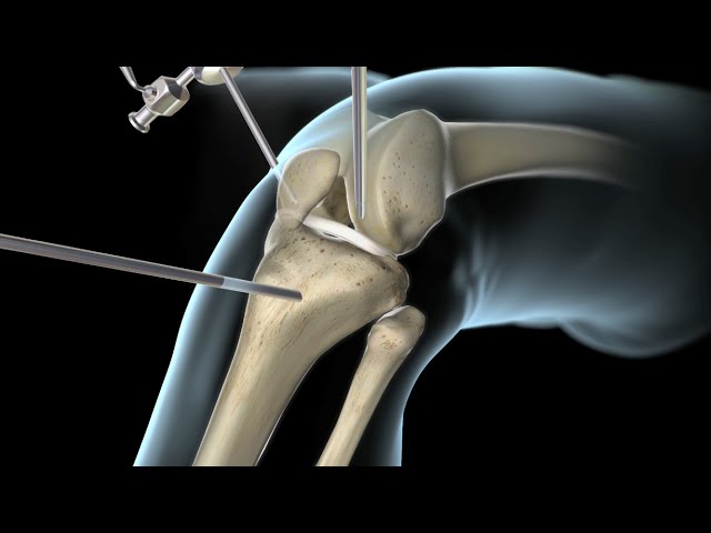 operacion de ligamento cruzado y menisco