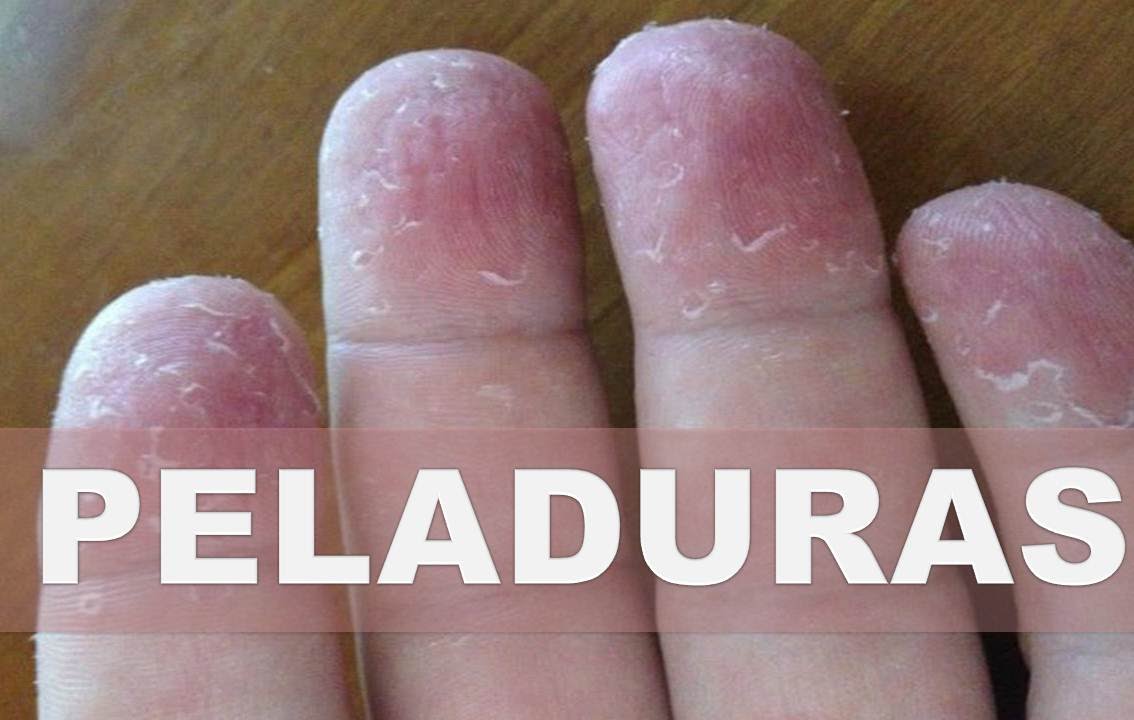 palmas de las manos peladas