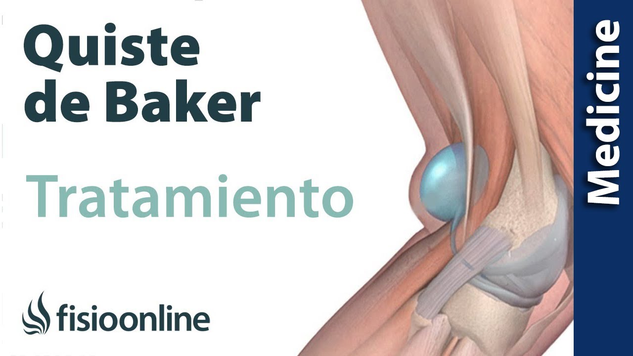 quiste de baker tratamiento fisioterapia
