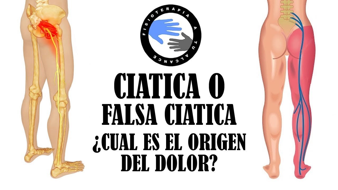 diferencia entre ciática y falsa ciática