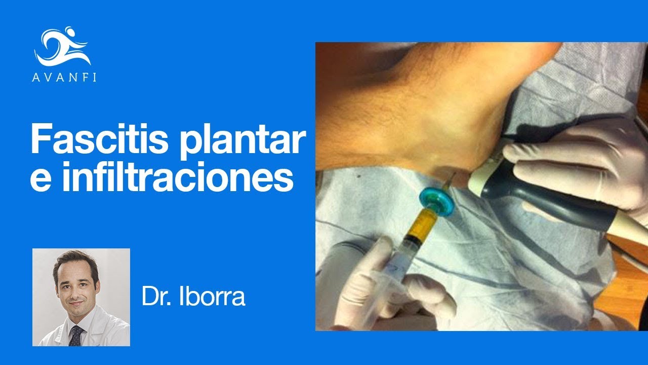 duelen las infiltraciones en el pie