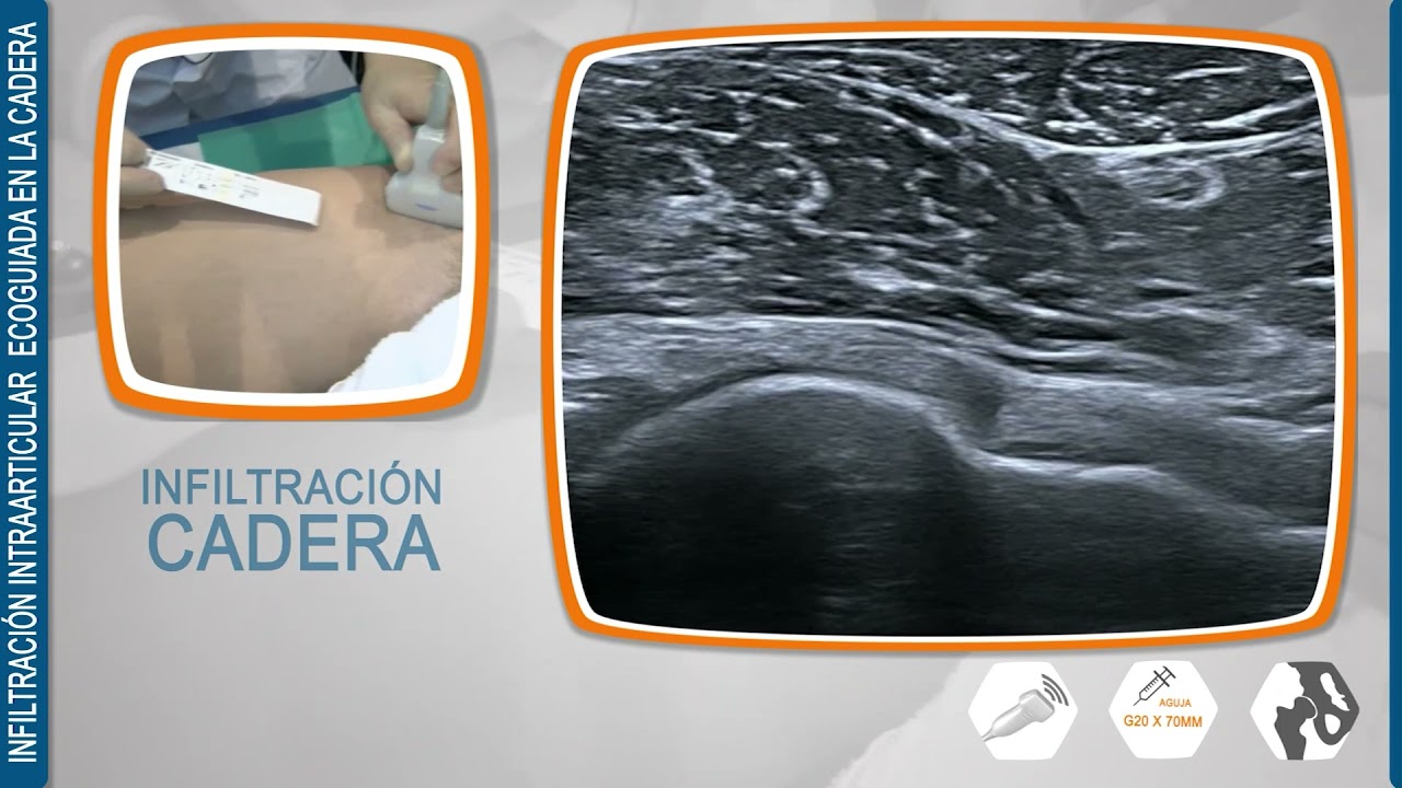 infiltracion de cadera guiada por ecografia