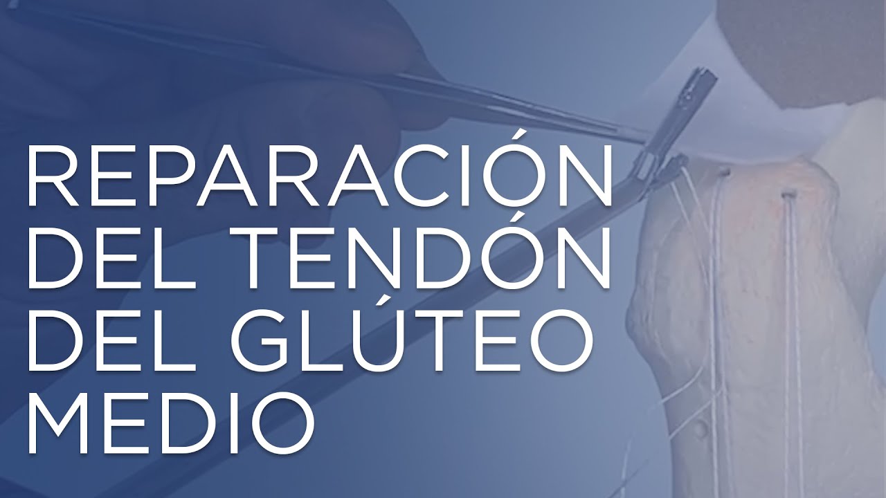 rotura del gluteo medio tiempo de recuperacion